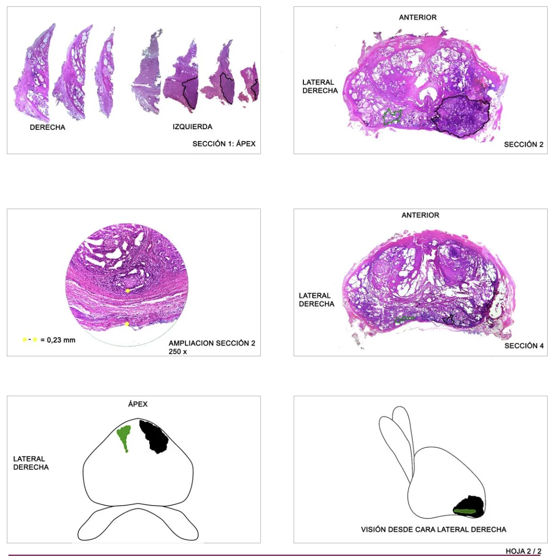 Página gráfica de un informe de anatomía patológica: cortes completos de la próstata teñidos, con los focos de tumor contorneados, una ampliación al microscopio y dos mapas esquemáticos de la próstata.